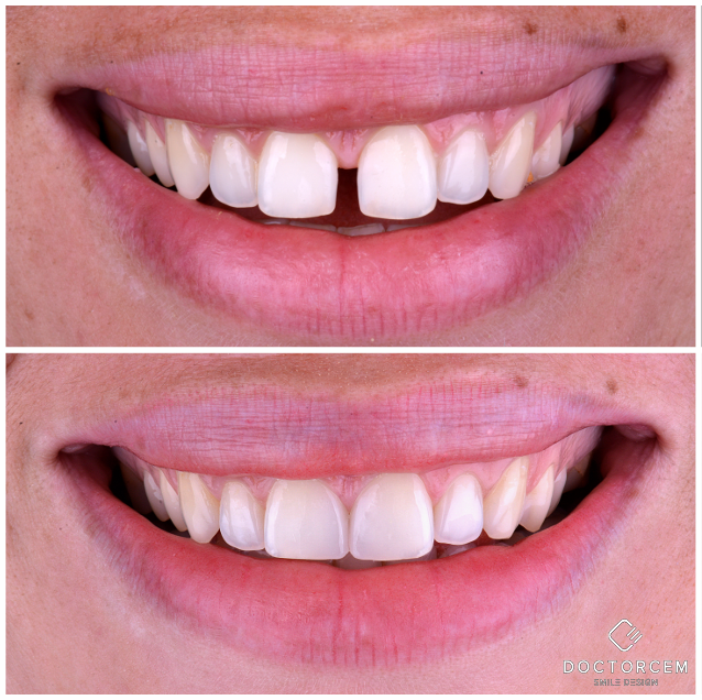 Smile transformation case 1