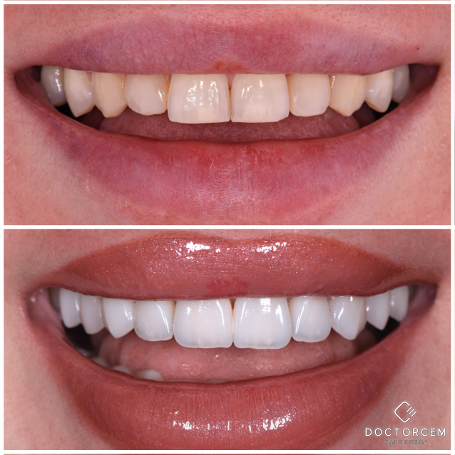 Smile transformation case 2