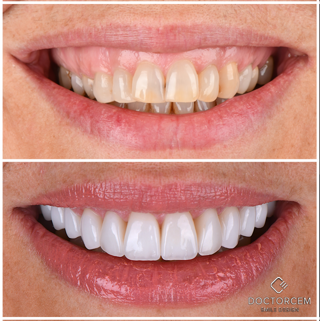 Smile transformation case 3