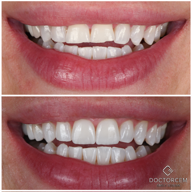 Smile transformation case 4