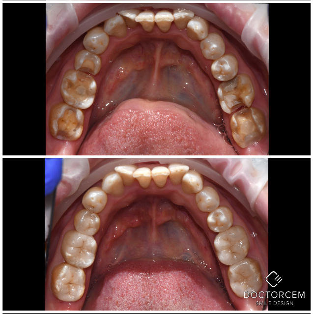 Smile transformation case 5