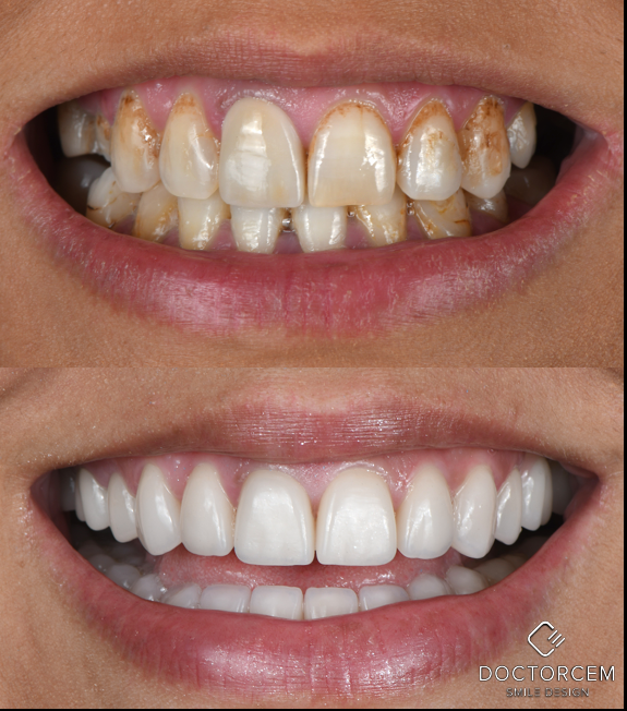 Smile transformation case 6