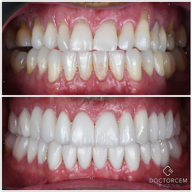 Smile transformation case 7