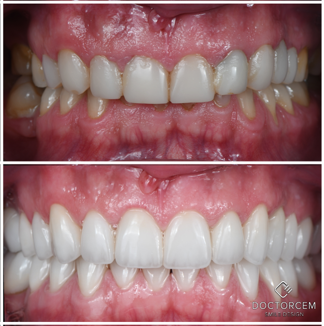 Smile transformation case 8