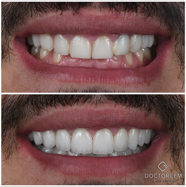Smile transformation case 9