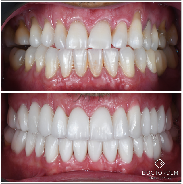 Smile transformation case 10