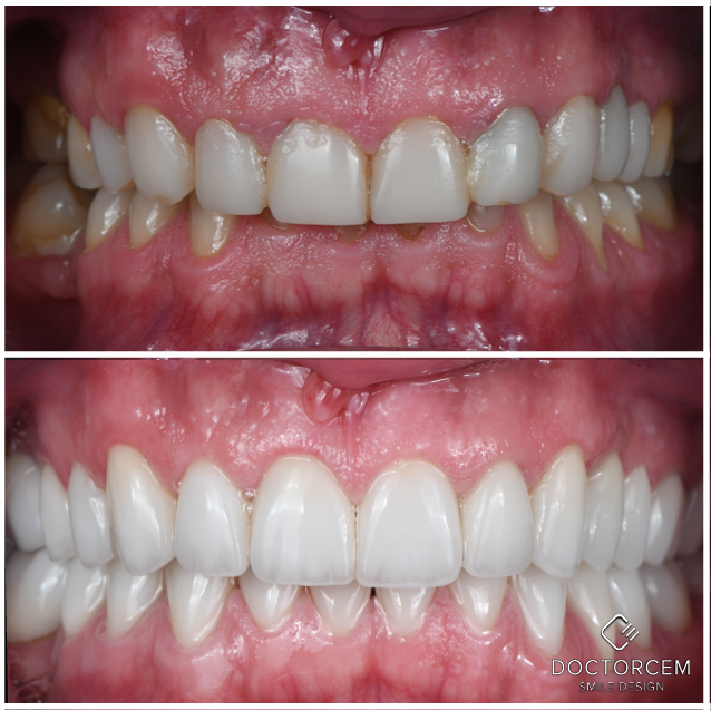Smile transformation case 11