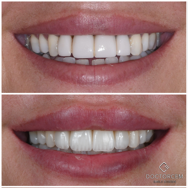 Smile transformation case 12